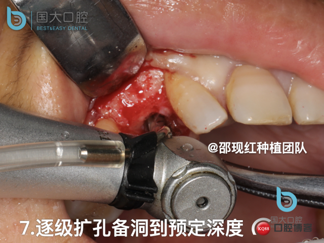 周晶 右上3数字化导板种植 以终为始的导板种植 sic导板 放射假牙，蜡牙 美学种植.045.jpeg