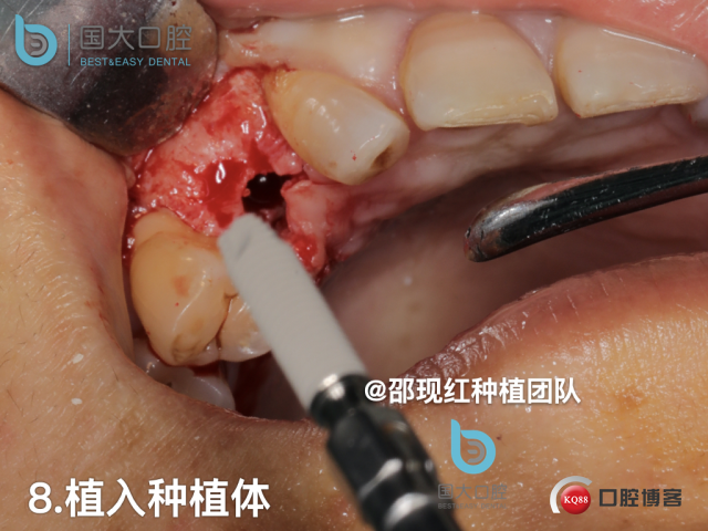 周晶 右上3数字化导板种植 以终为始的导板种植 sic导板 放射假牙，蜡牙 美学种植.046.jpeg