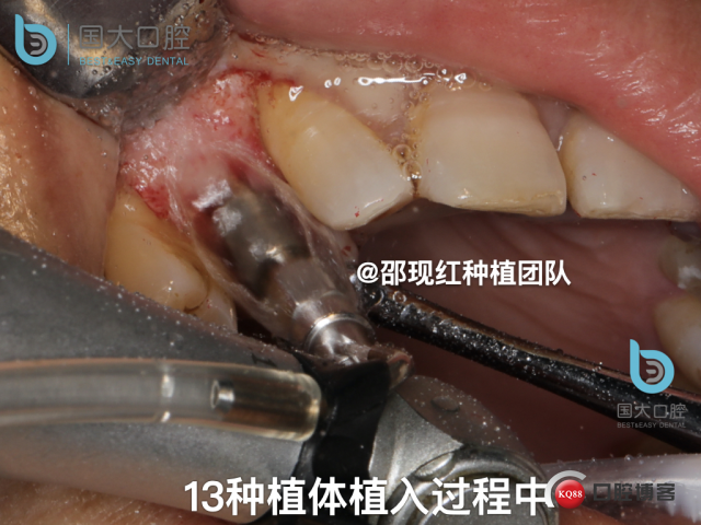 周晶 右上3数字化导板种植 以终为始的导板种植 sic导板 放射假牙，蜡牙 美学种植.047.jpeg