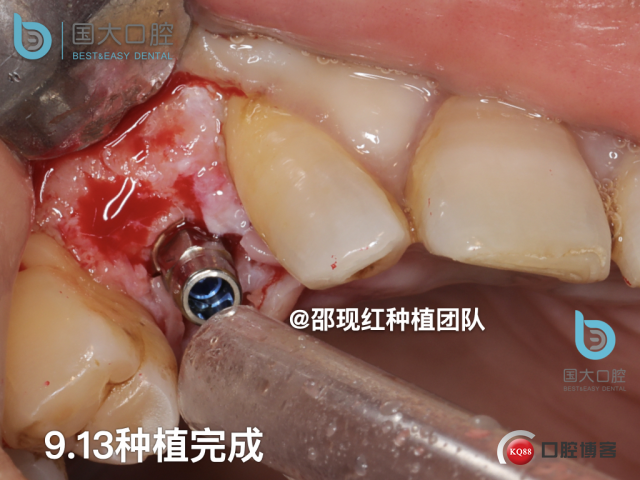 周晶 右上3数字化导板种植 以终为始的导板种植 sic导板 放射假牙，蜡牙 美学种植.048.jpeg