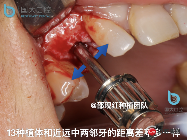 周晶 右上3数字化导板种植 以终为始的导板种植 sic导板 放射假牙，蜡牙 美学种植.049.jpeg