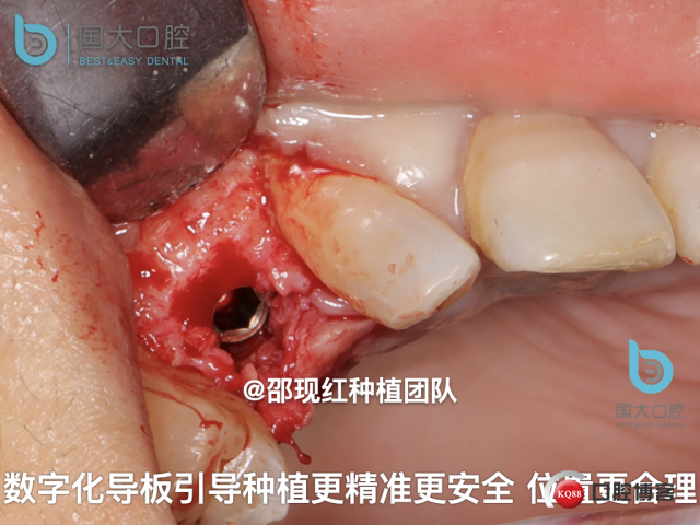 周晶 右上3数字化导板种植 以终为始的导板种植 sic导板 放射假牙，蜡牙 美学种植.050.jpeg