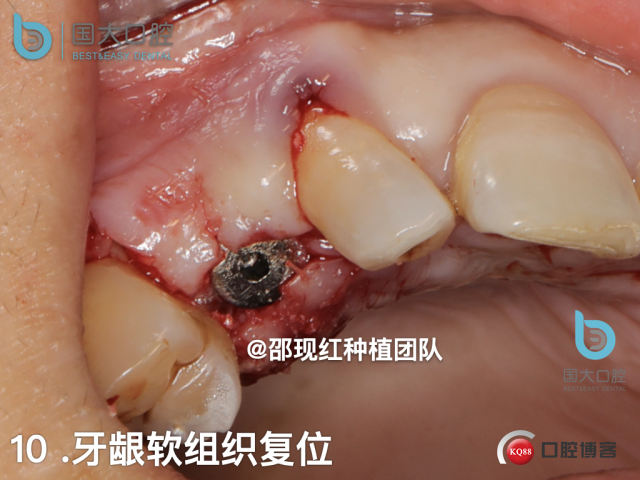 周晶 右上3数字化导板种植 以终为始的导板种植 sic导板 放射假牙，蜡牙 美学种植.051.jpeg