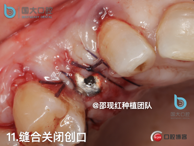 周晶 右上3数字化导板种植 以终为始的导板种植 sic导板 放射假牙，蜡牙 美学种植.052.jpeg