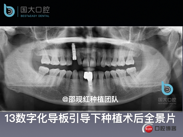 周晶 右上3数字化导板种植 以终为始的导板种植 sic导板 放射假牙，蜡牙 美学种植.053.jpeg