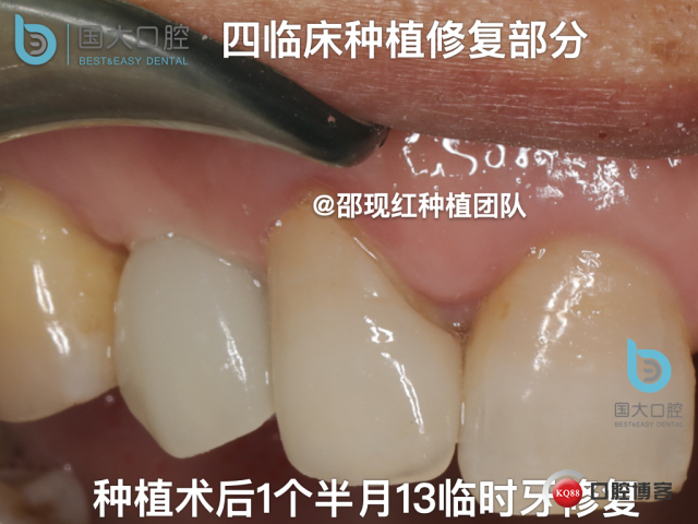 周晶 右上3数字化导板种植 以终为始的导板种植 sic导板 放射假牙，蜡牙 美学种植.054.jpeg