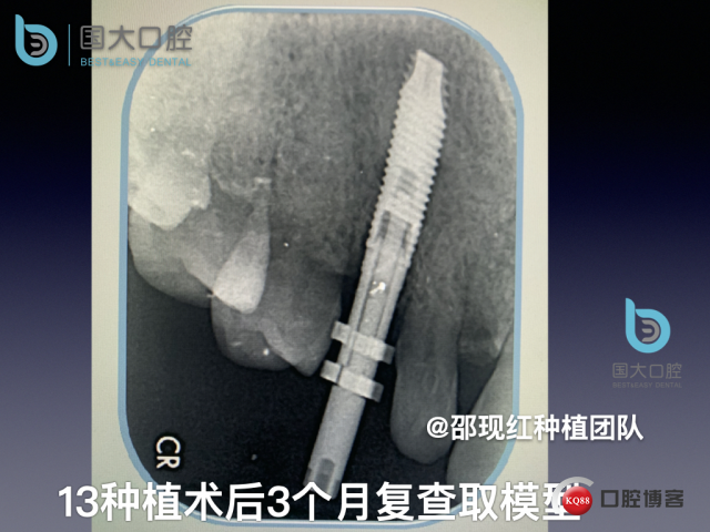 周晶 右上3数字化导板种植 以终为始的导板种植 sic导板 放射假牙，蜡牙 美学种植.055.jpeg