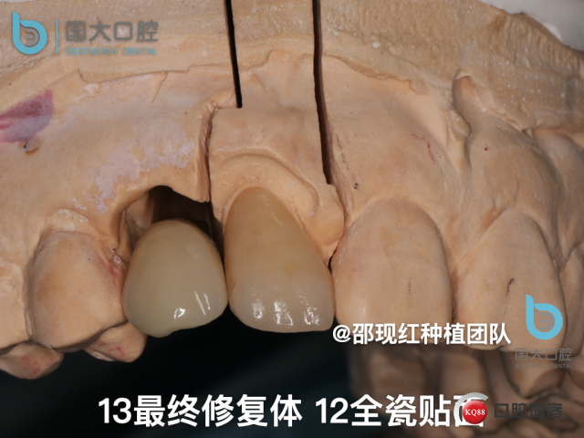 周晶 右上3数字化导板种植 以终为始的导板种植 sic导板 放射假牙，蜡牙 美学种植.056.jpeg