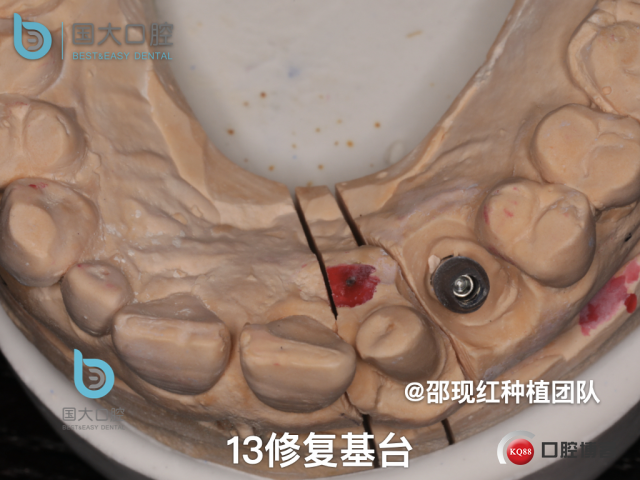 周晶 右上3数字化导板种植 以终为始的导板种植 sic导板 放射假牙，蜡牙 美学种植.057.jpeg