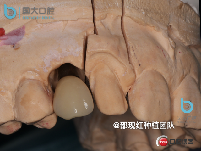 周晶 右上3数字化导板种植 以终为始的导板种植 sic导板 放射假牙，蜡牙 美学种植.058.jpeg