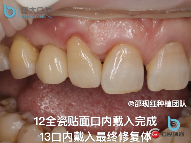 周晶 右上3数字化导板种植 以终为始的导板种植 sic导板 放射假牙，蜡牙 美学种植.059.jpeg