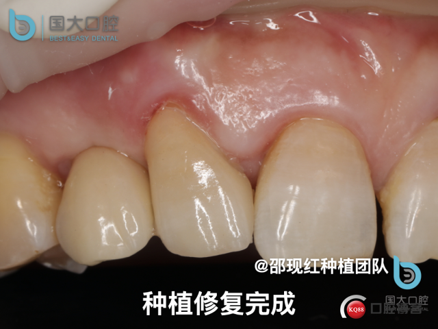 周晶 右上3数字化导板种植 以终为始的导板种植 sic导板 放射假牙，蜡牙 美学种植.060.jpeg