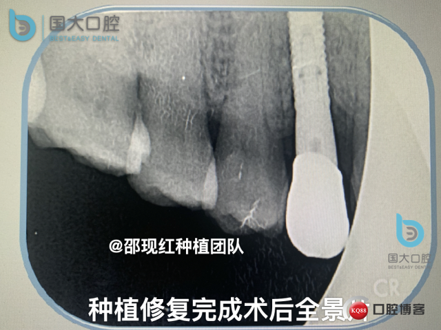 周晶 右上3数字化导板种植 以终为始的导板种植 sic导板 放射假牙，蜡牙 美学种植.061.jpeg
