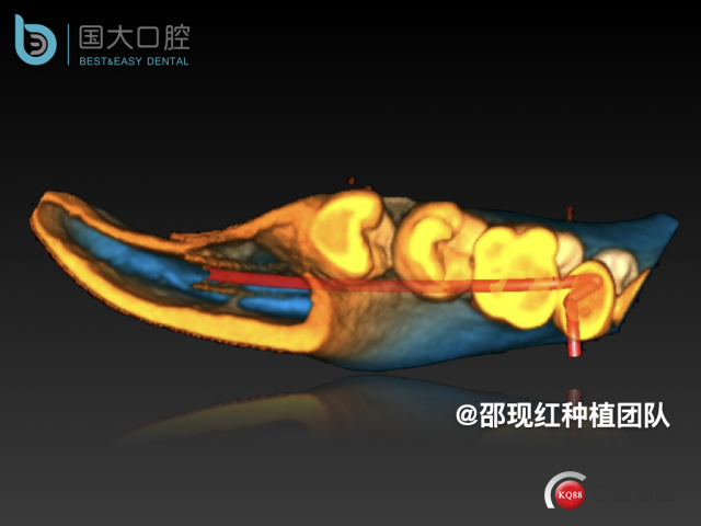 陈承恩 右下8智齿拔除.010.jpeg