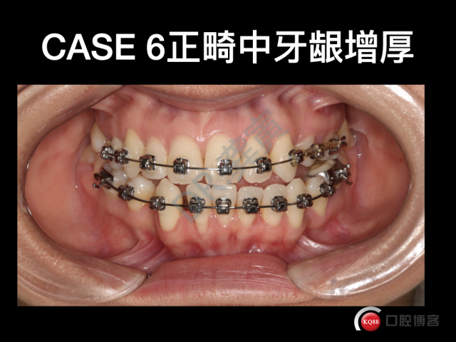 牙周—正畸联合治疗的病例分析 .001.jpeg
