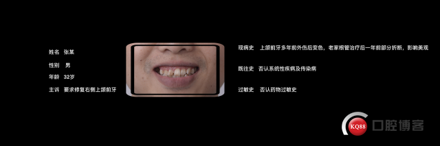 前牙变色修复.002.jpeg