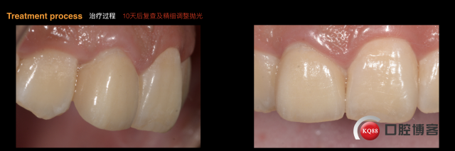 前牙变色修复.025.jpeg