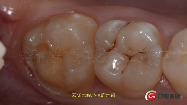 牙体缺损的修复方法7.004.jpeg