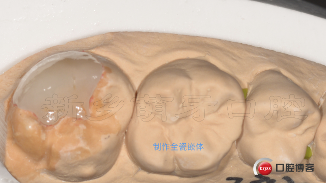 牙体缺损的修复方法7.005.jpeg