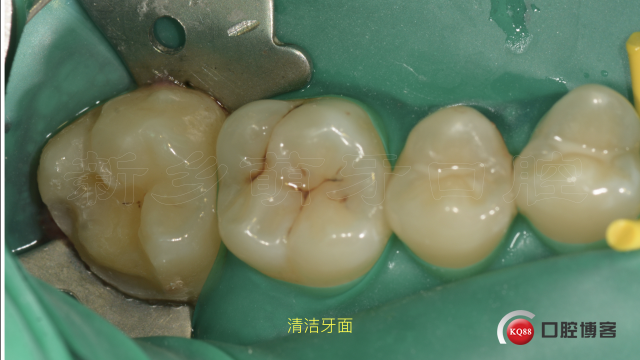 牙体缺损的修复方法7.007.jpeg