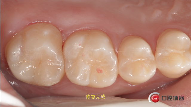 牙体缺损的修复方法7.010.jpeg