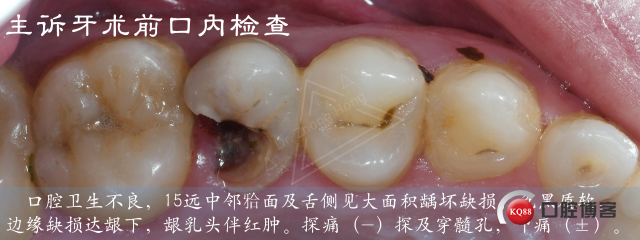 糊剂超出赛道 黄牌警告-右上前磨牙根管治疗后桩冠修复-Dr. Zhong Hong_03.jpg