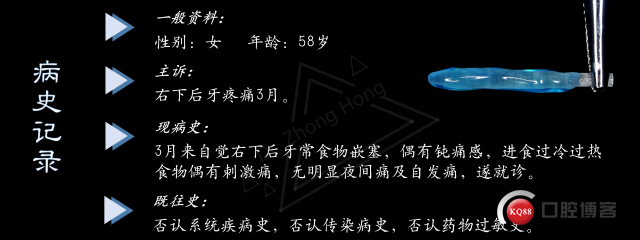 纤维桩“打”与“放”的选择—右下前磨牙根管治疗后桩冠修复—Dr. Zhong Hong_02.jpg