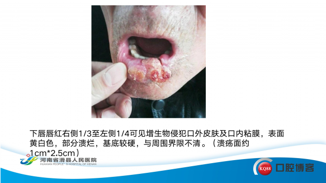 一例下唇唇癌切除后缺损即刻唇颊组织瓣修复+韩世权+滑县人民医院+15896812583_04.png