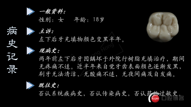 旧换新颜之天然牙形态恢复-左下磨牙树脂充填-Dr. Zhong Hong_02.jpg