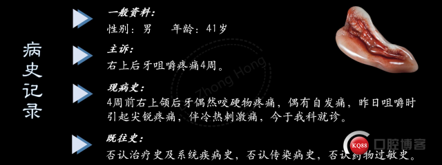 腔中石，去与留-右上第一磨牙隐裂所致牙髓炎-Dr. Zhong Hong_02.jpg