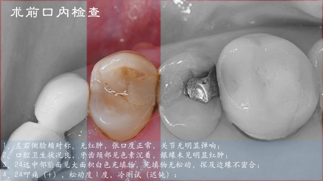 推本溯源，探索窦道真相-左上前磨牙根管治疗-Dr.Zhong Hong_03.jpg
