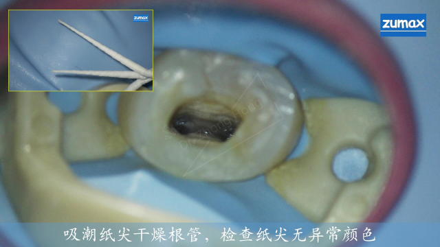 推本溯源，探索窦道真相-左上前磨牙根管治疗-Dr.Zhong Hong_31.jpg