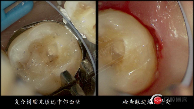 不虞之隙，是否已成定局-右下第二磨牙根管治疗后冠修复-Dr. Zhong Hong_11.jpg