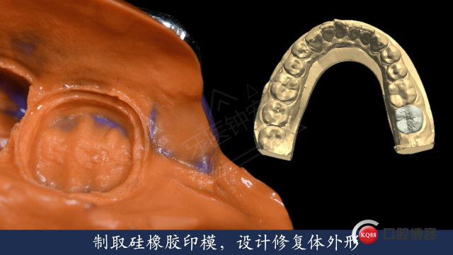 不虞之隙，是否已成定局-右下第二磨牙根管治疗后冠修复-Dr. Zhong Hong_28.jpg