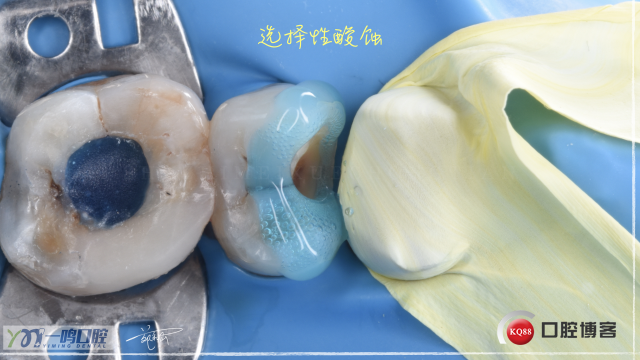 15二类洞 树脂充填16:9.006.jpeg