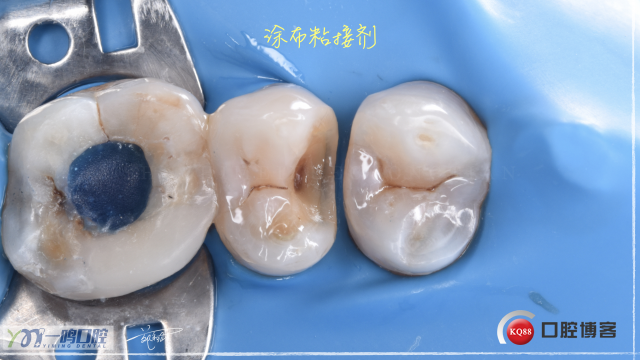 15二类洞 树脂充填16:9.008.jpeg