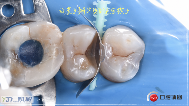 15二类洞 树脂充填16:9.009.jpeg