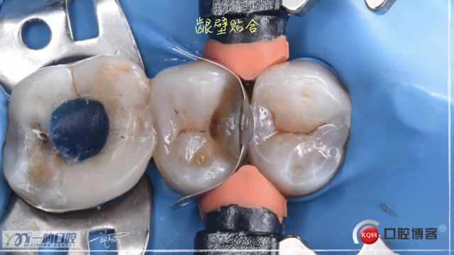15二类洞 树脂充填16:9.011.jpeg