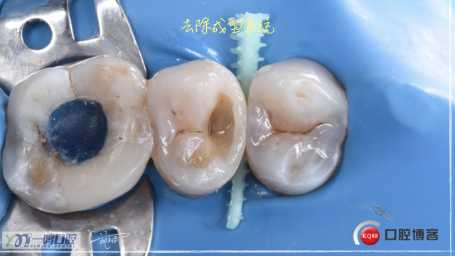 15二类洞 树脂充填16:9.014.jpeg