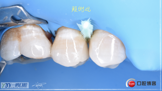 15二类洞 树脂充填16:9.015.jpeg