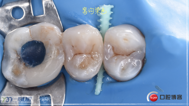 15二类洞 树脂充填16:9.018.jpeg