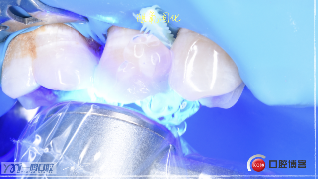 15二类洞 树脂充填16:9.019.jpeg
