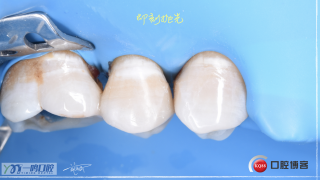 15二类洞 树脂充填16:9.022.jpeg