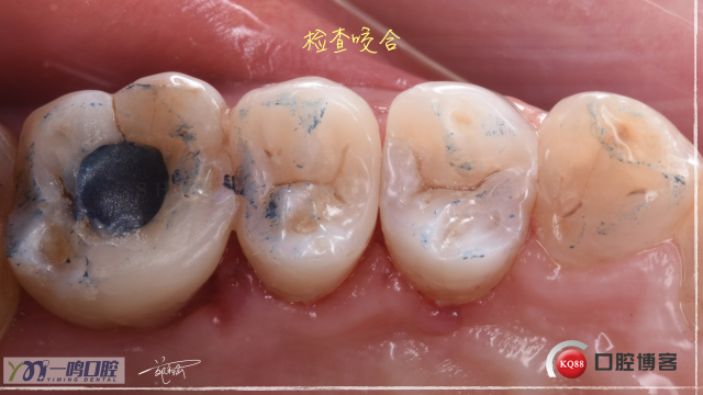 15二类洞 树脂充填16:9.024.jpeg