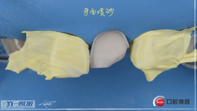 瓷贴面16:9   21.008.jpeg