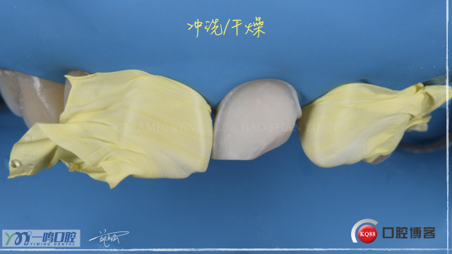 瓷贴面16:9   21.010.jpeg