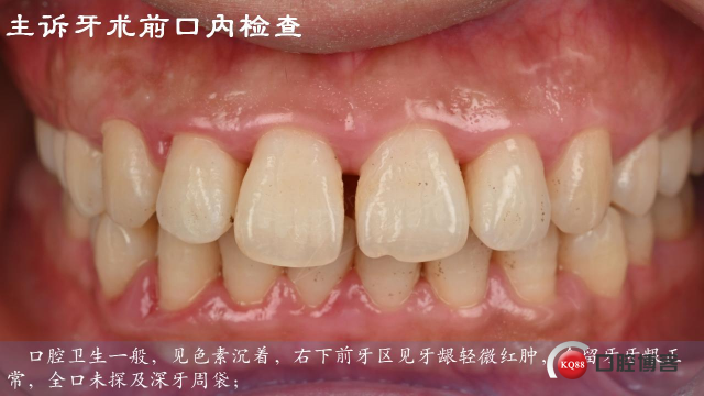 流动树脂高效修复前牙间隙—显微操作下的缝隙终结者—Dr. Zhong Hong_03.jpg