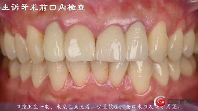 离心根管荡洗系统联合激光—慢性根尖周炎再治疗的增效策略-Dr. Zhong Hong_03.jpg